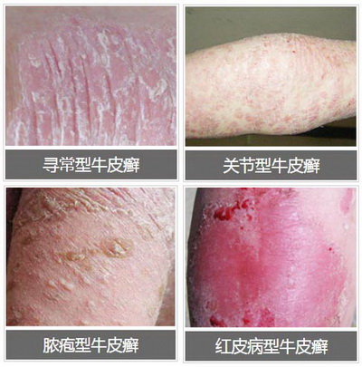 牛皮癣 中医渗透抗癣疗法