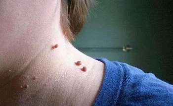 脖子上长疣是什么原因引起的